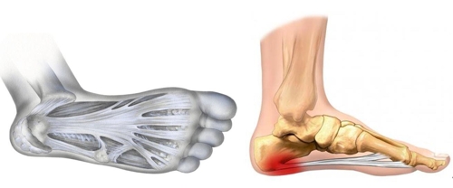 족저근막과 족저근막염 발생 부위/. 사진=연합뉴스