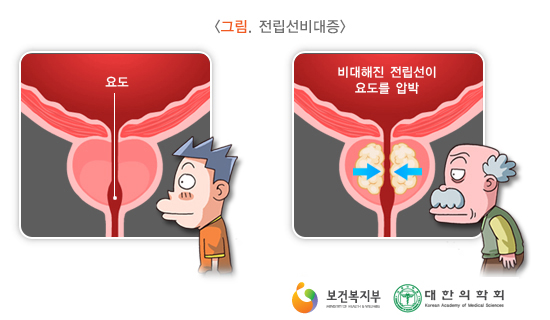 전립선비대증/사진=국가건강정보포털