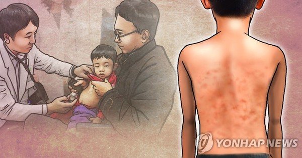 홍역 /사진=연합뉴스