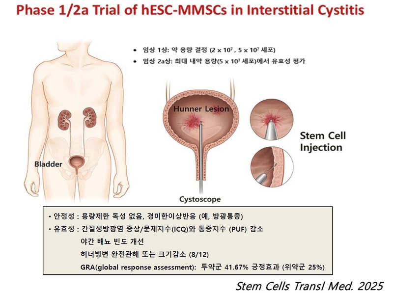 난치성 질환 간질성방광염 줄기세포치료 세계 첫 임상시험 성공 - 뉴스 썸네일 이미지