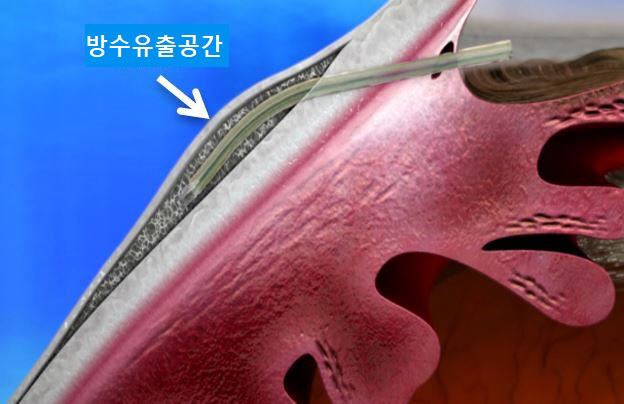 녹내장 스텐트 삽입술