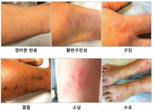 빈대 물렸을 때 증상과 대처법은?