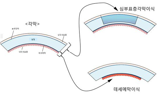 부분층 각막이식술