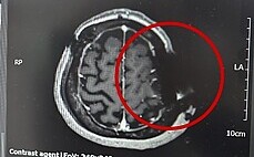 톱날 머리뼈 박힌 채 봉합…뇌수술 환자 '황당'