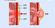 새해 '몸짱' 욕심내다 탈장 진단