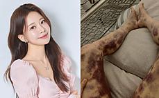 주사 시술 '전신 피멍' 아옳이, 소송 승소